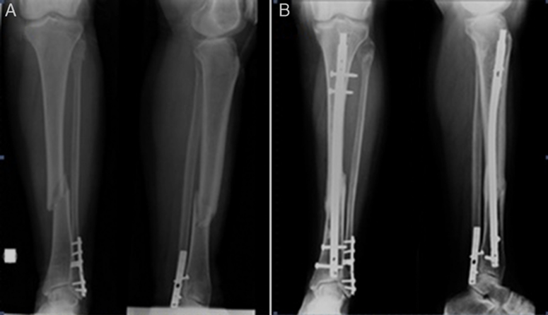 Fractura de Tibia y/o Peroné