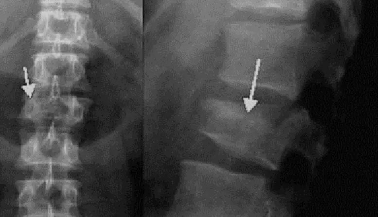 Fractura de Vértebra